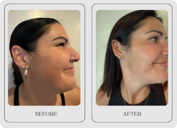 Skin treatment transformation comparison showing before and after results of facial improvement.