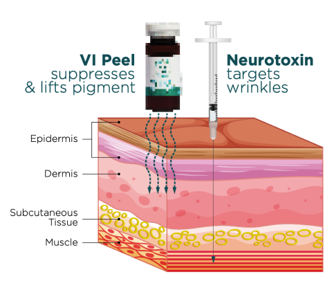 VI Peel suppresses pigment in the epidermis while neurotoxin targets wrinkles in deeper skin layers.