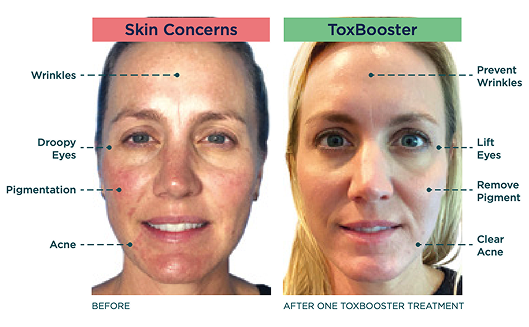 Before-and-after comparison of ToxBooster treatment effects on skin concerns.