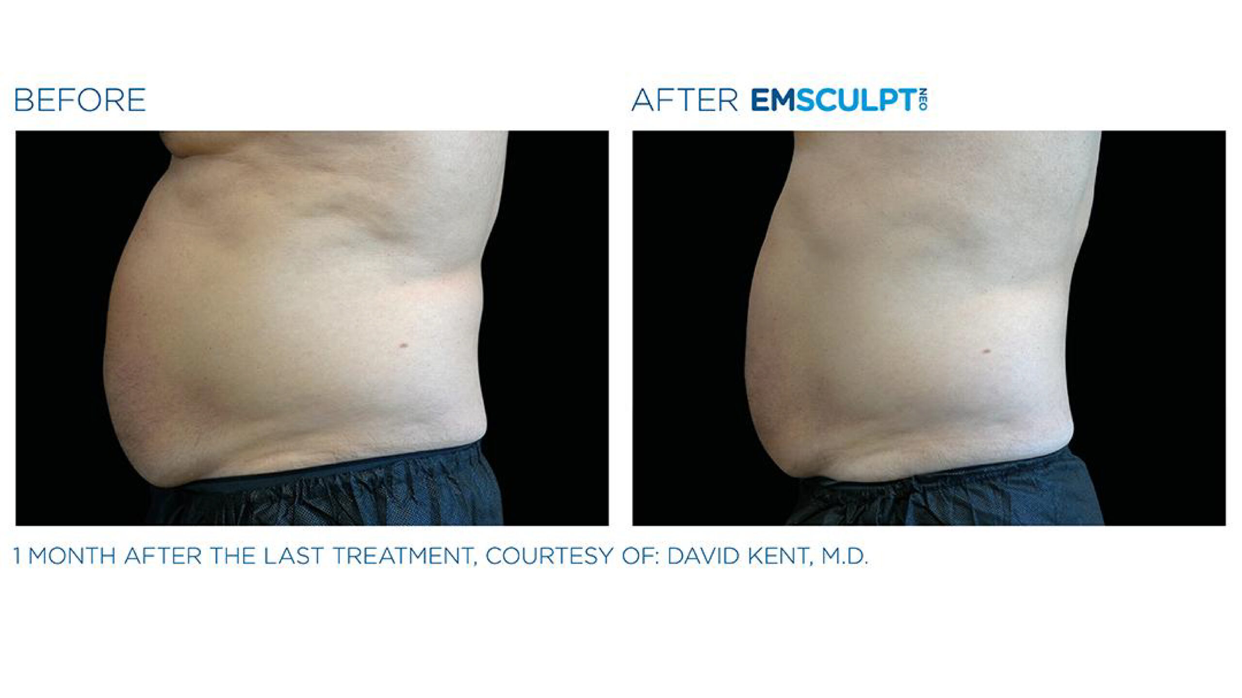 Before-and-after comparison of abdominal area treated with EMSculpt technology.