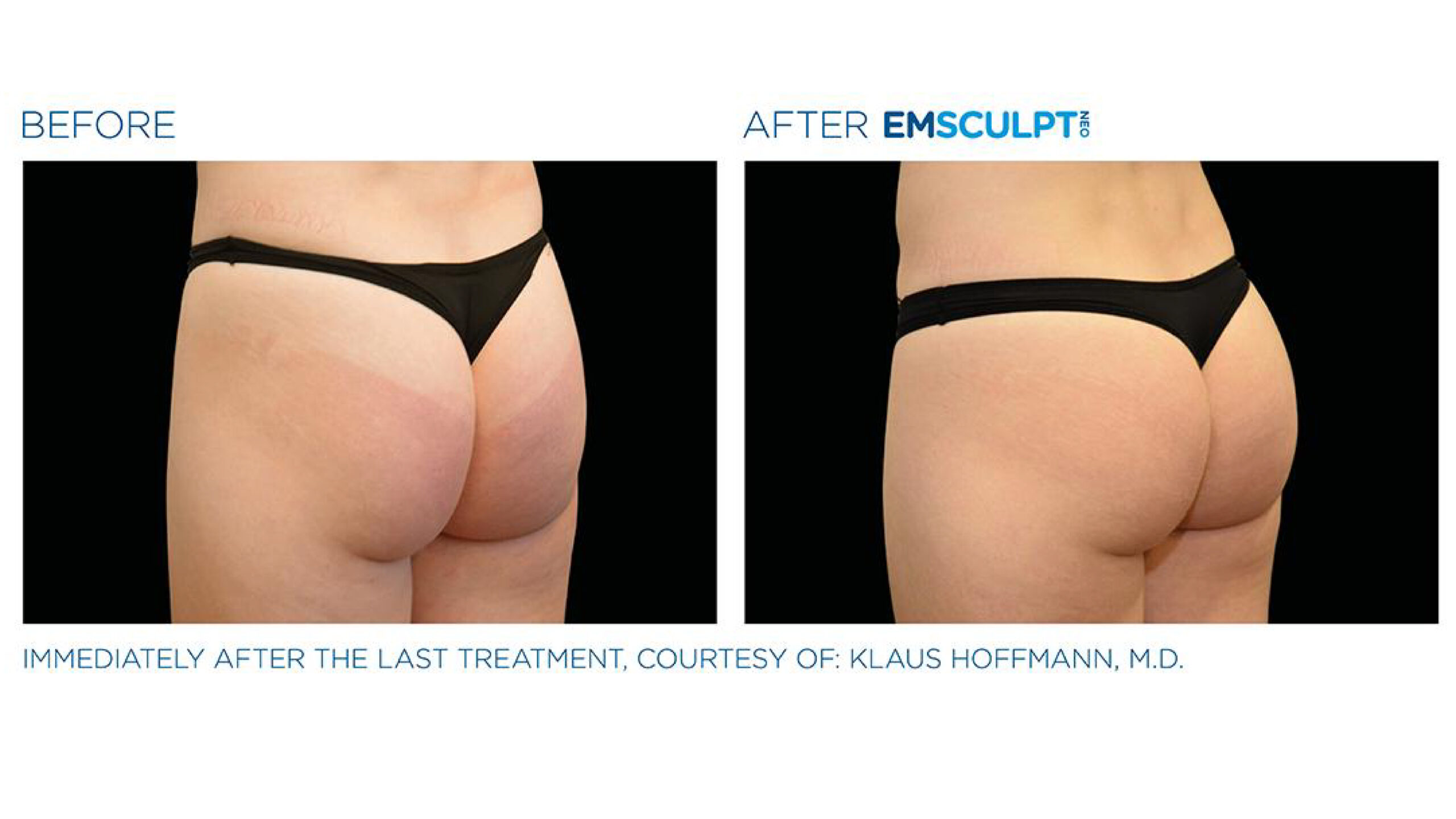 Before and after comparison of buttock enhancement using EMSculpt treatment.